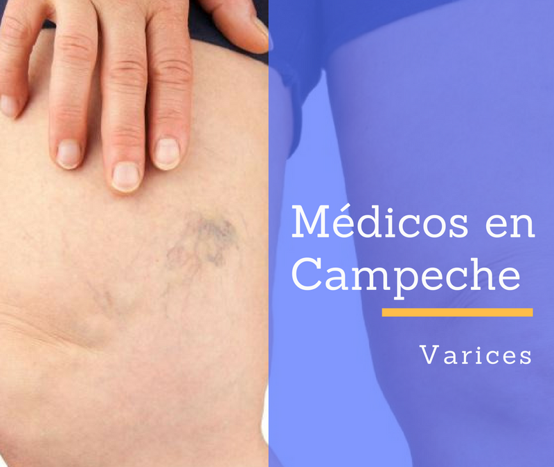 Varices