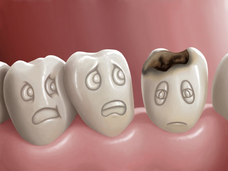 Caries por accidente en tratamiento de ortodoncia.